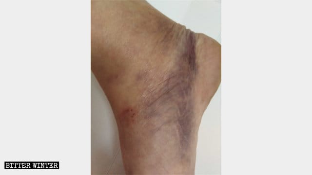 폭행으로 웨이 씨의 발에 남은 상처