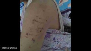 두 명의 전능신교 신자 중 한 사람의 팔에 남은 고문 흉터