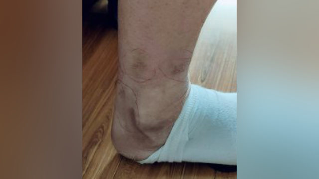 전기봉으로 당한 고문에 자오 씨의 발에는 수많은 상흔이 남아 있다